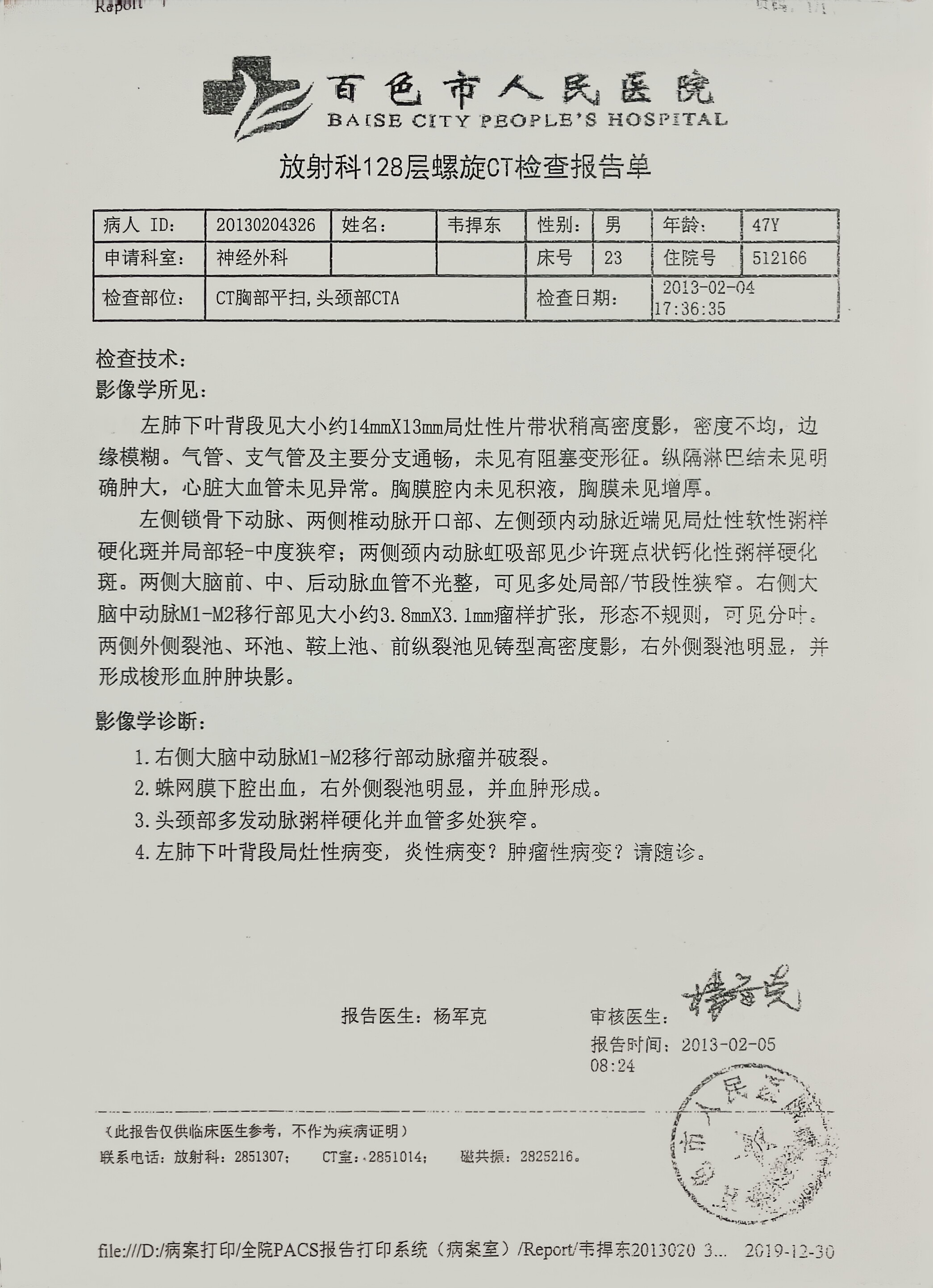 头部CT报告——脑动脉瘤破裂、蛛网膜下腔出血