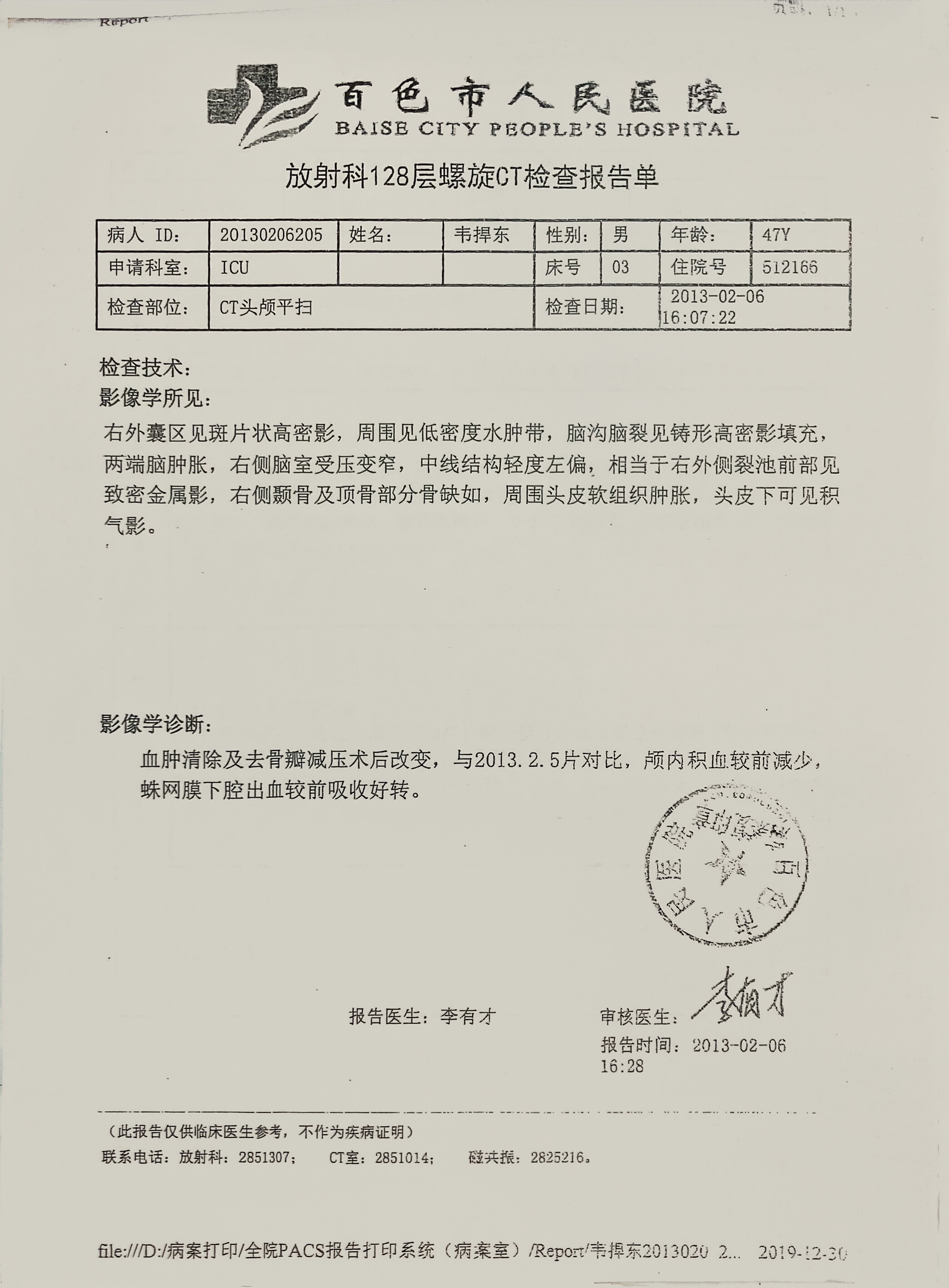 血肿清除及去骨瓣减压术后复查CT